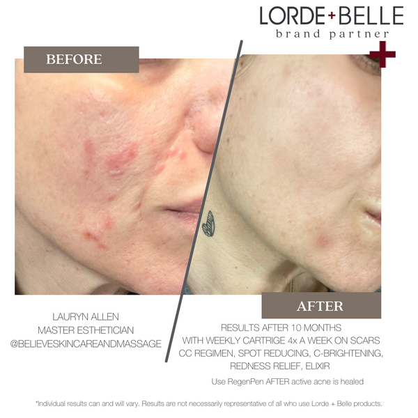 Gentle Care for Sensitive Skin: Lorde and Belle's Expert Tips