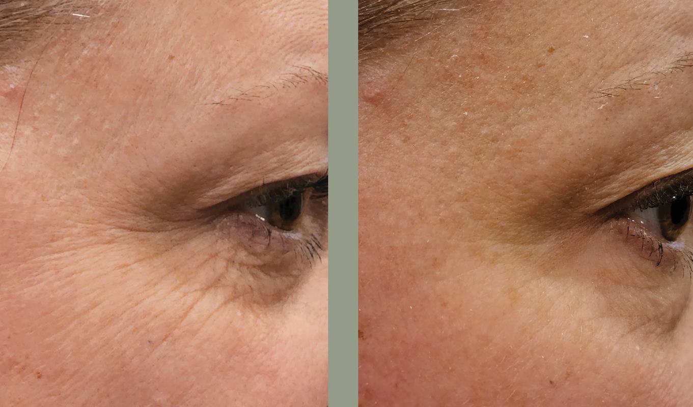 A women highlighting reduced wrinkles and improved skin texture in before and after image