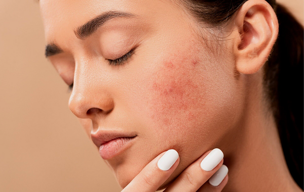 Is my skin purging or breaking out? Let’s figure it out together.